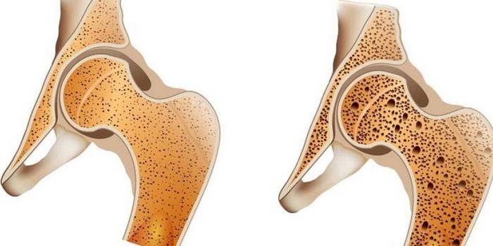 Normálna kosť (vľavo) a osteoporóza