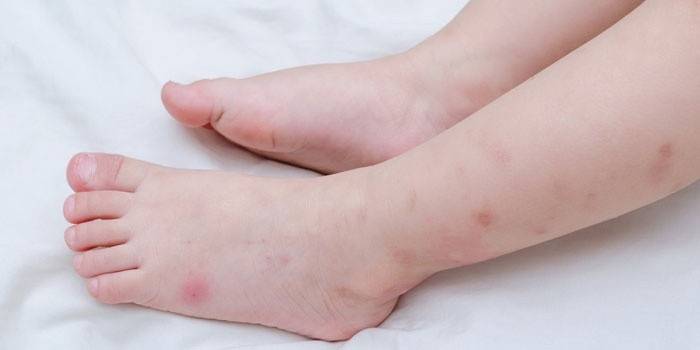 Traços de picadas de mosquito nos pés de uma criança
