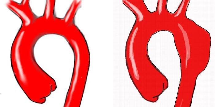 Aorta torácica saudável e com alterações patológicas