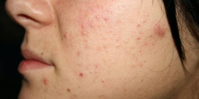Alergia facial