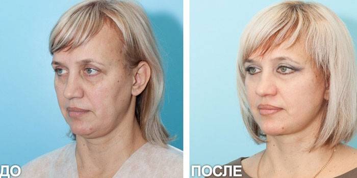 Fotografie ženy pred a po zdvíhaní SMAS