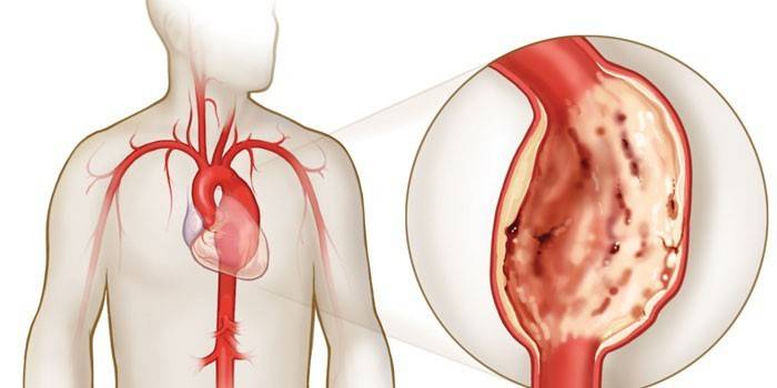 Como é um aneurisma da aorta?