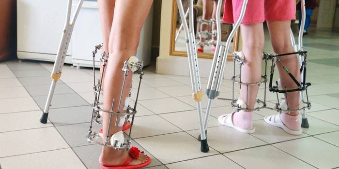 Mulheres de muletas e com o aparelho de Ilizarov nas pernas