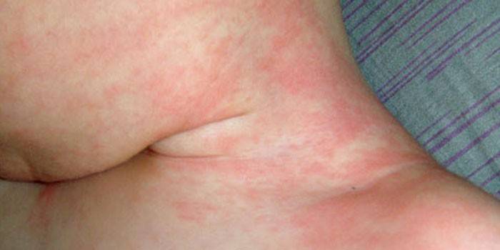 Uma erupção no corpo do bebê