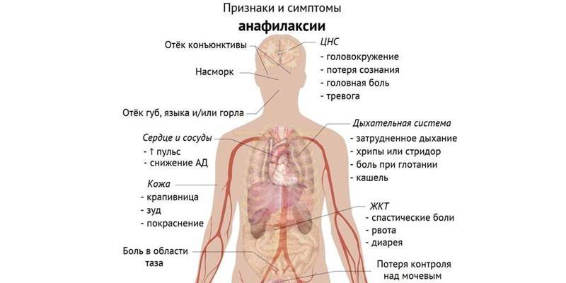 Oznaki i objawy anafilaksji
