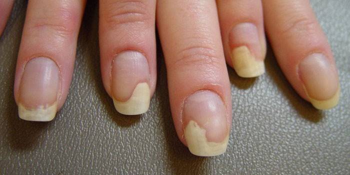 La manifestación de hongos en las uñas en las manos.