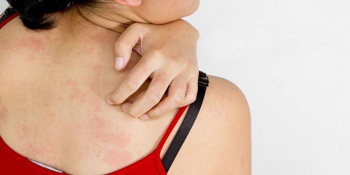 Zdjęcie alergicznej wysypki na plecach dziewczynki