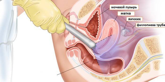 Esquema de ultrasonido transvaginal.