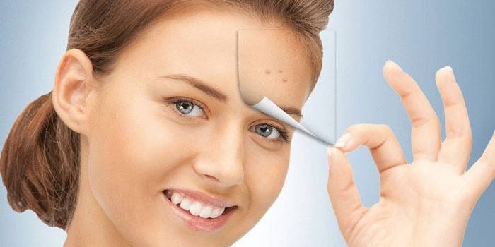 Garota se livrar da acne na testa