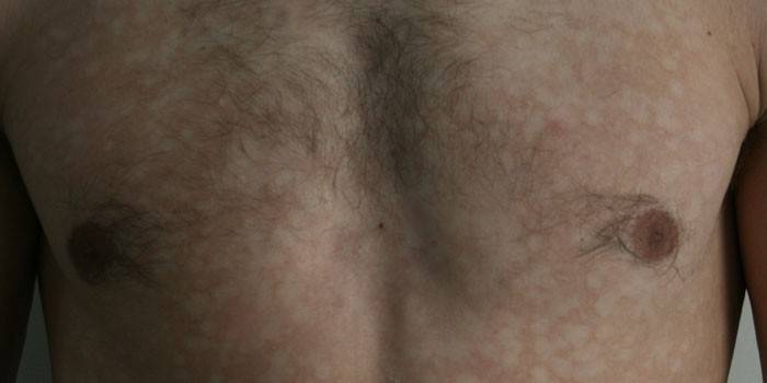 Pityriasis versicolor