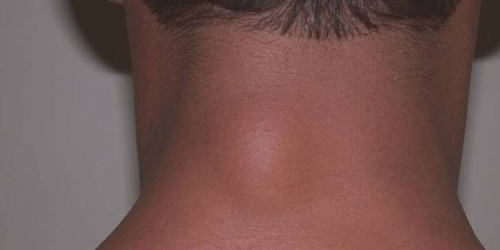 Zhirovik (lipoma) no pescoço