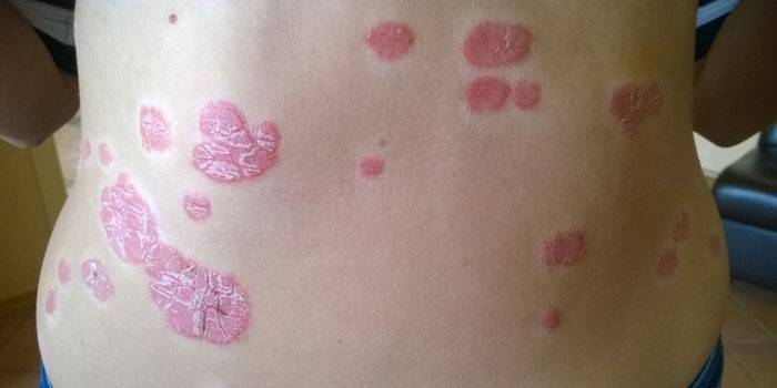 Placas psoriásicas en la espalda de una persona.