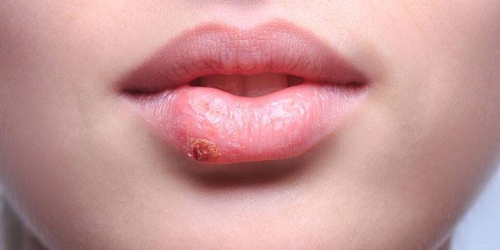 Herpes no lábio de uma menina