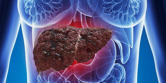 Hígado en el cuerpo de una mujer afectada por hepatosis grasa