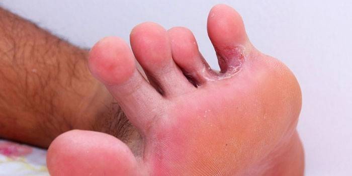 Grzyb Toe