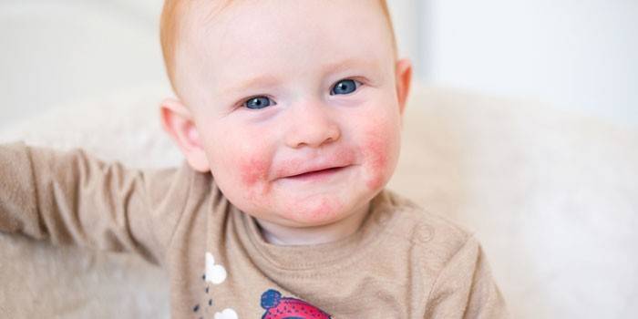 Dermatitis en un niño