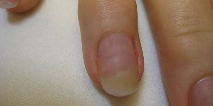 Onicomicosis de uñas