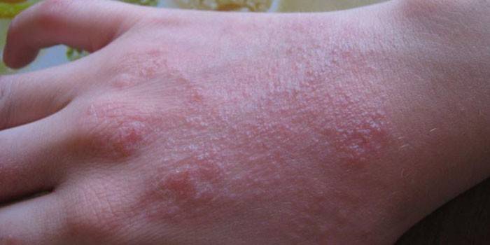 Eczema seco na pele