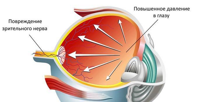 Esquema de aumento da pressão intra-ocular e danos no nervo óptico
