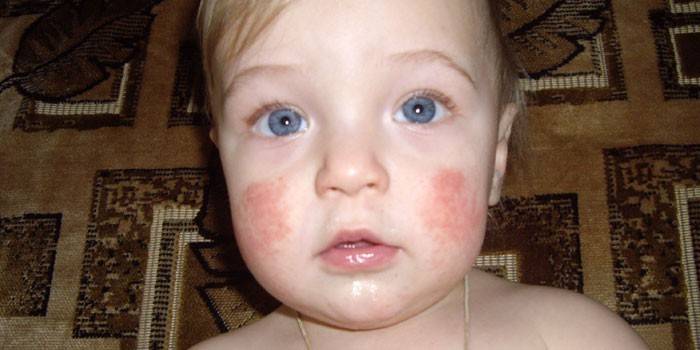 Dermatitis atópica en las mejillas de un niño.