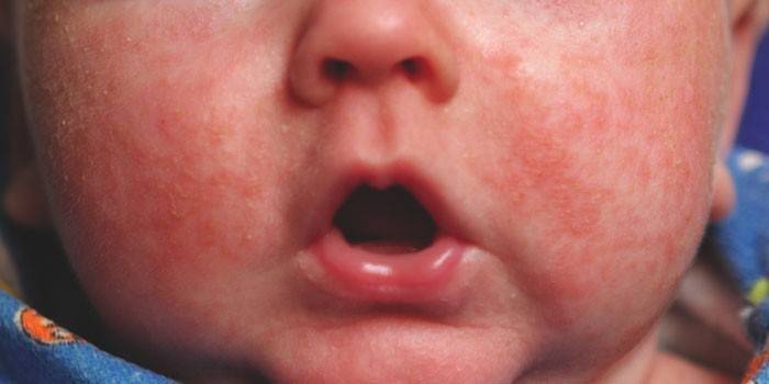 Dermatitis alérgica en un niño