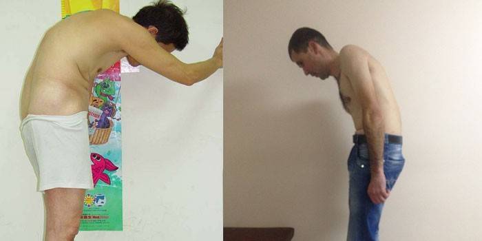 Hombres con espondilitis anquilosante
