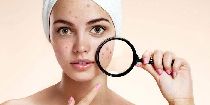 A garota tem acne no rosto