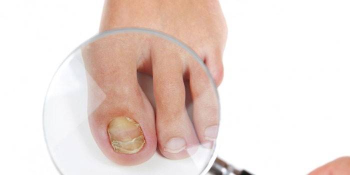 Grzyb Toe