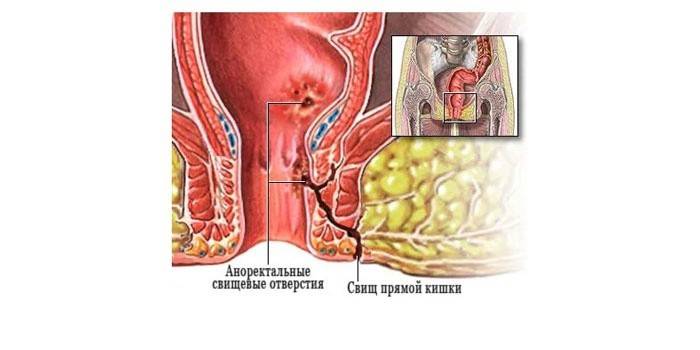Rektálna fistula
