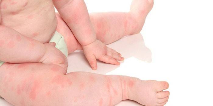 Urticária aguda no corpo de uma criança pequena
