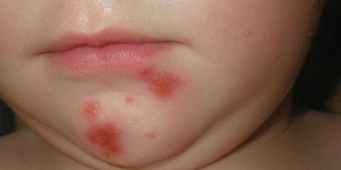 Streptoderma em uma criança