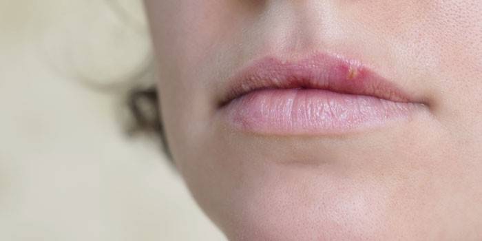 Herpes na pery