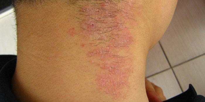Neurodermatitis en el cuello