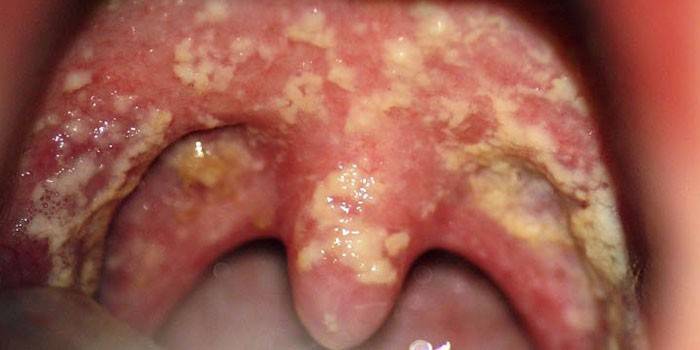 Manifestaciones de candidiasis en las amígdalas.