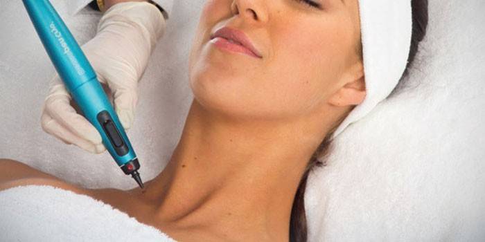 Remoção de raio laser de um tumor