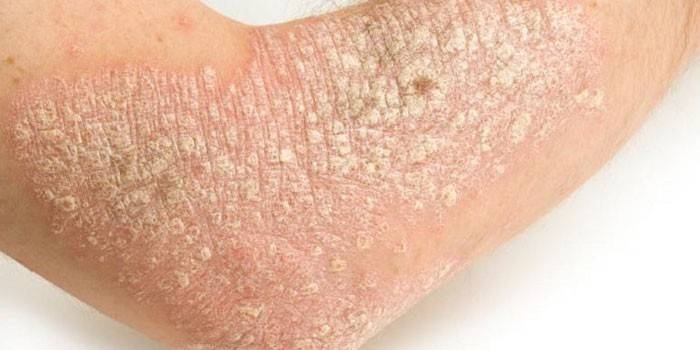 Psoriasis en la piel de la mano.