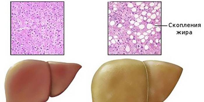 Hígado sano e hígado afectado por esteatosis