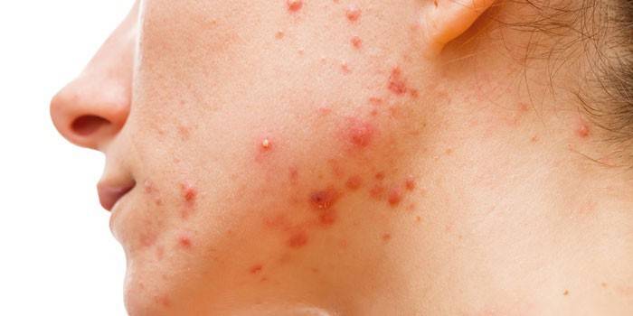 Ostry wyprysk mikrobiologiczny na twarzy