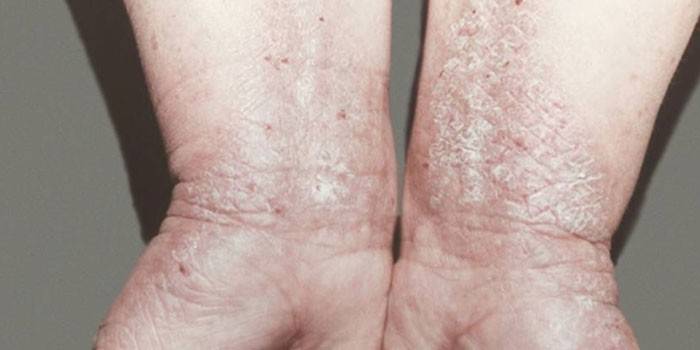 Neurodermatitis en las manos