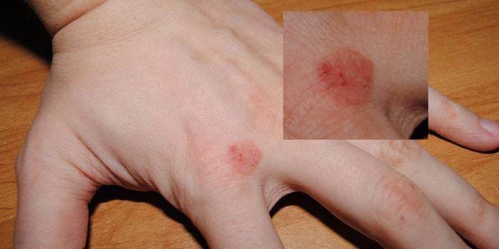 Manifestaciones de neurodermatitis focal en la piel del brazo.