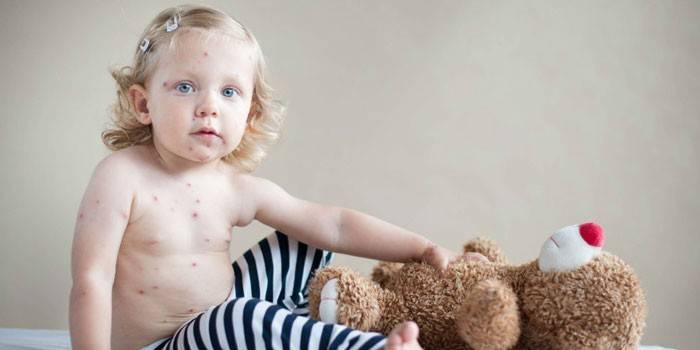 La niña tiene urticaria