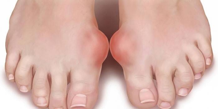 Gota en los pies