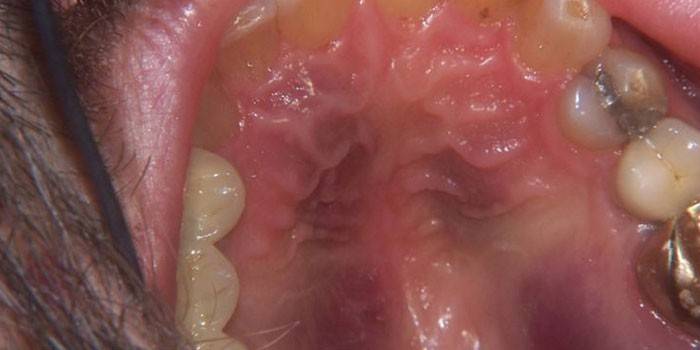 Sarcoma Kaposi en el cielo