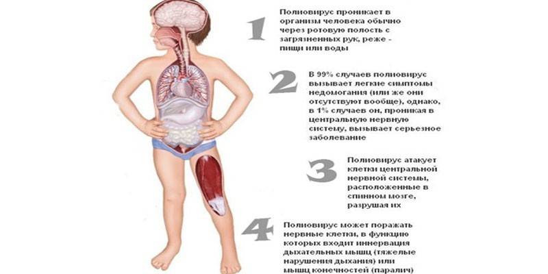 Polio en niños