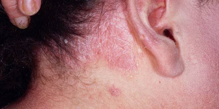 Dermatite seborréica atrás da orelha