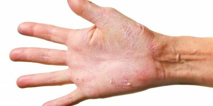 Dermatomykóza na paži