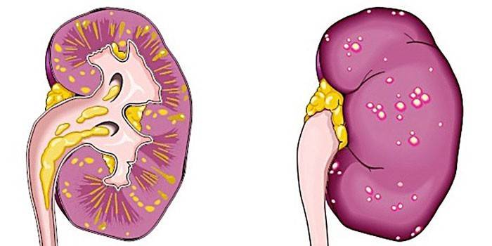 Esquema de pielonefritis aguda