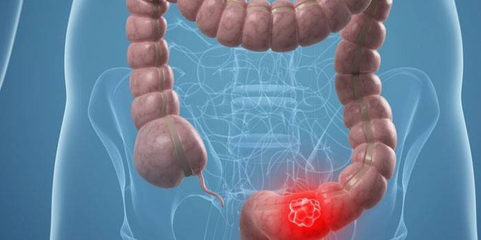 El diseño del colon sigmoide.