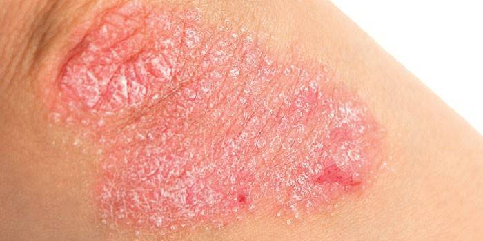 Psoriasis en la piel del codo.