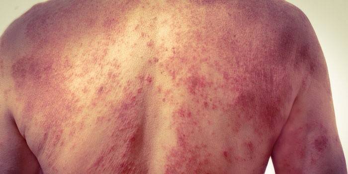 Pitiríase versicolor nas costas de um homem